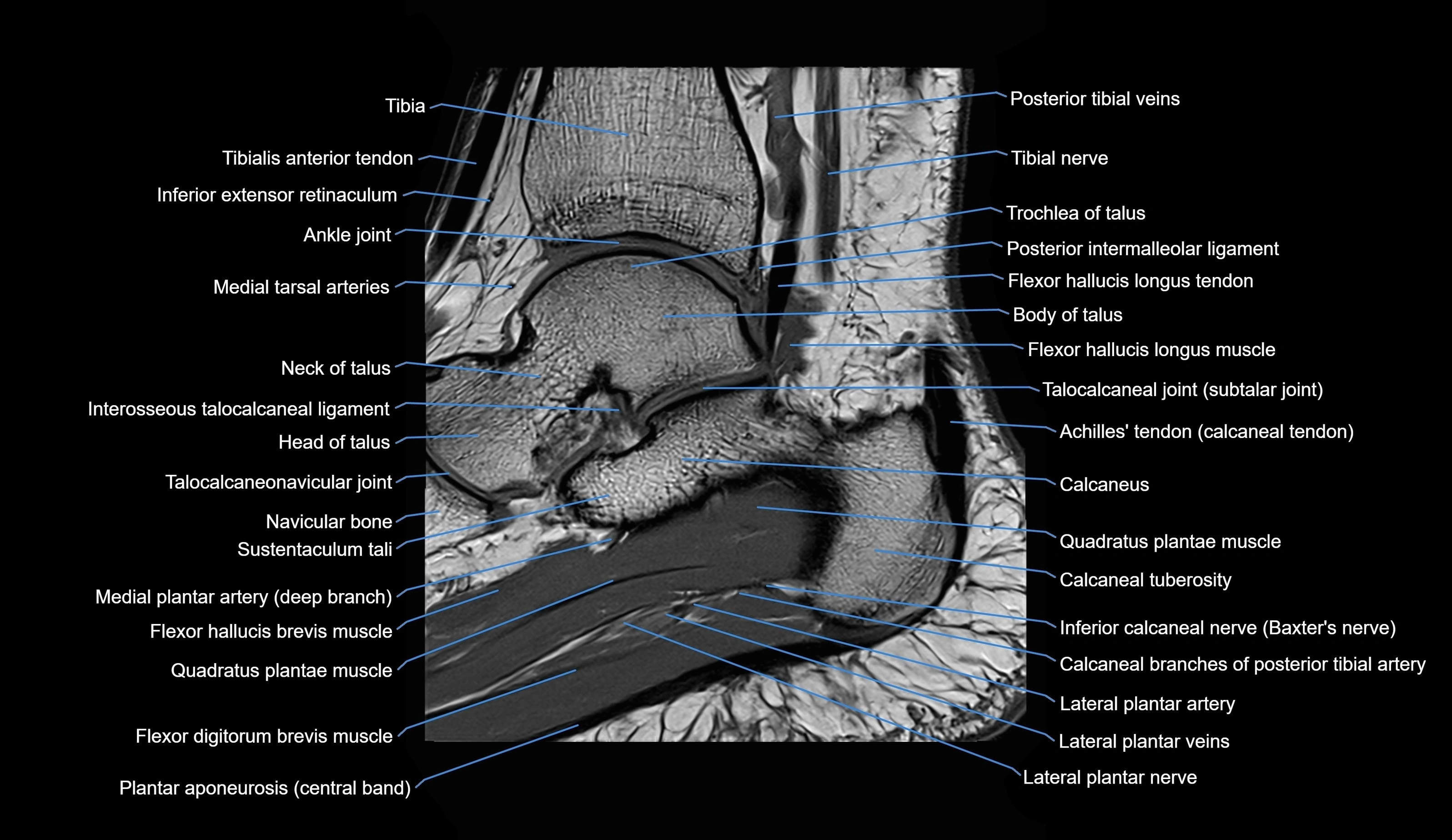 MRI Ankle sagittal cross sectional anatomy 3T  radiology  image-img-00001-00015.webp